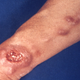 A photo of cutaneous leishmaniasis, taken in 1965.